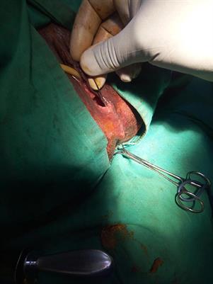 A Case of Low Rectovaginal Fistula of Obstetric Origin: Treatment by Fistulotomy and Reconstitution or Advancement Flap?